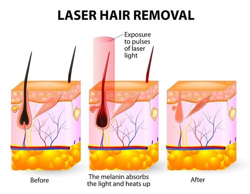 Máy triệt lông Ống hai cực Tia laze 20HZ 808 Spa Salon