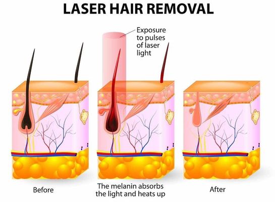 Máy đa chức năng OPT IPL / OPT Tẩy lông nhanh IPL di động