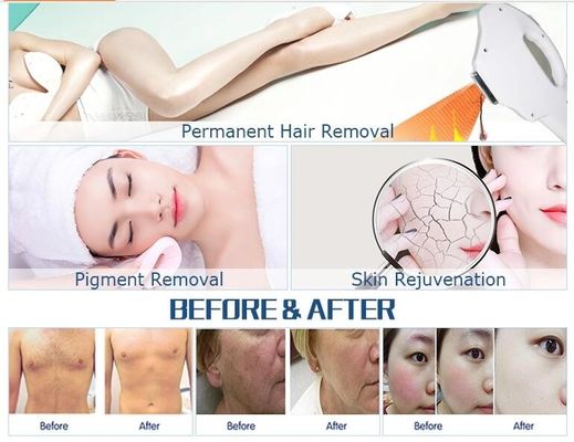 Máy đa chức năng OPT IPL / OPT Tẩy lông nhanh IPL di động